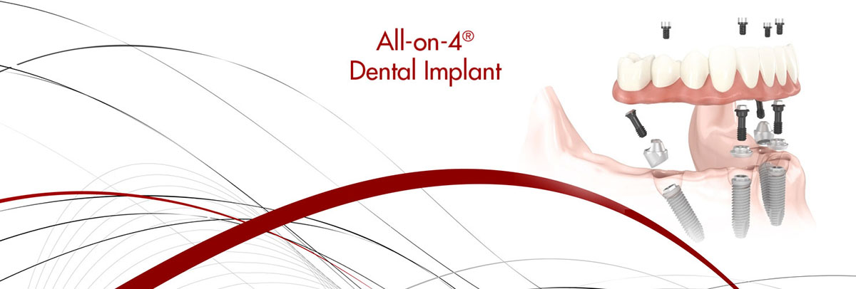Playa Vista All-on-4 Dental Implants