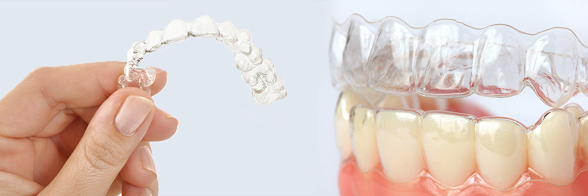 Playa Vista Alternative to Braces for Teens