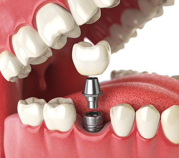 Will I Need a Bone Graft for Dental Implants?