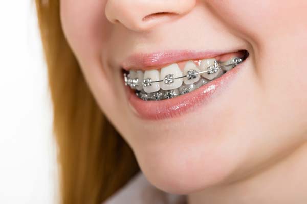 braces Playa Vista, CA