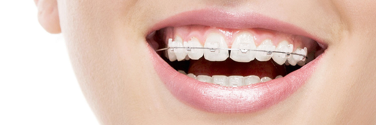 Playa Vista Invisible Orthodontics