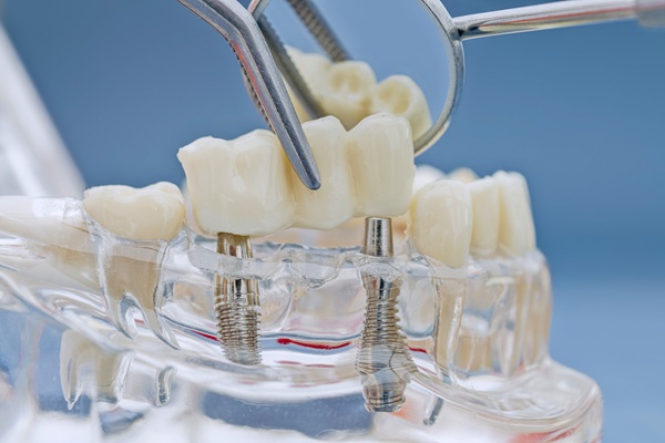 How Dentists Replace A Missing Tooth With A Dental Bridge