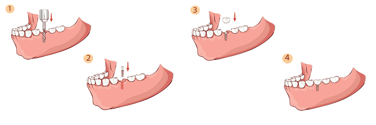 Playa Vista The Dental Implant Procedure