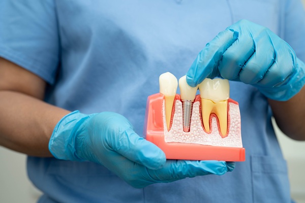 Reasons You May Not Be A Candidate For Dental Implants And How To Fix It