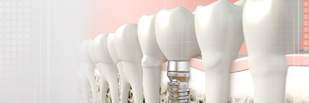 Playa Vista Dental Prosthetics