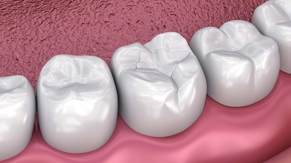 dental sealant Playa Vista, CA