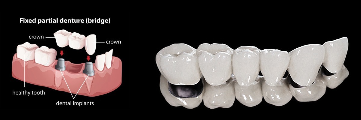 Playa Vista Dentures