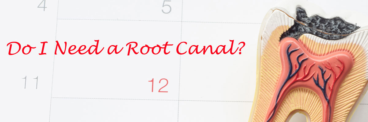 Playa Vista Do I Need a Root Canal