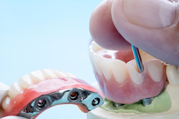 When Are Implant Supported Dentures Recommended?