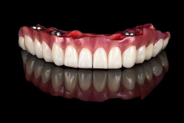 Tooth Replacement : A Guide To Implant Supported Dentures