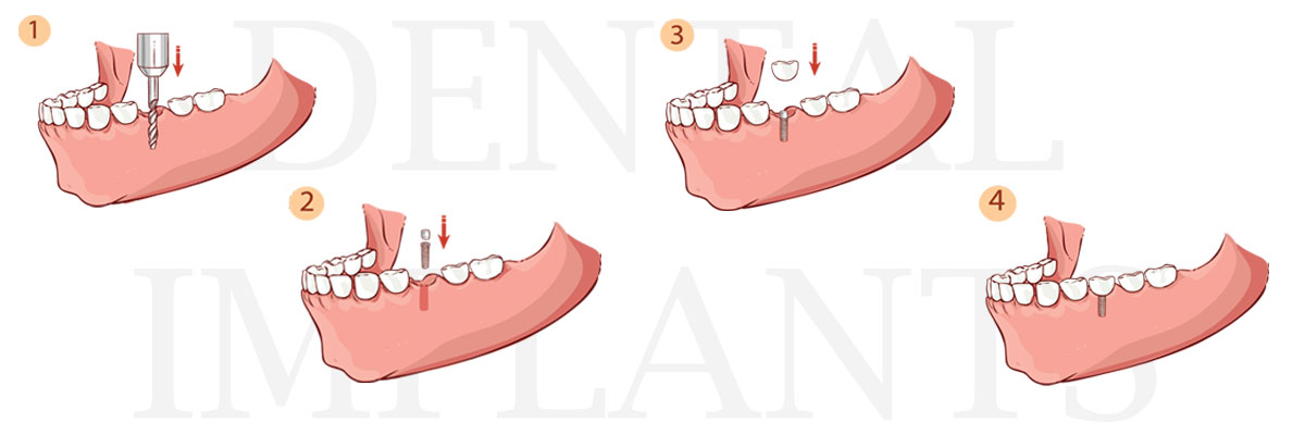 Playa Vista The Difference Between Dental Implants and Mini Dental Implants