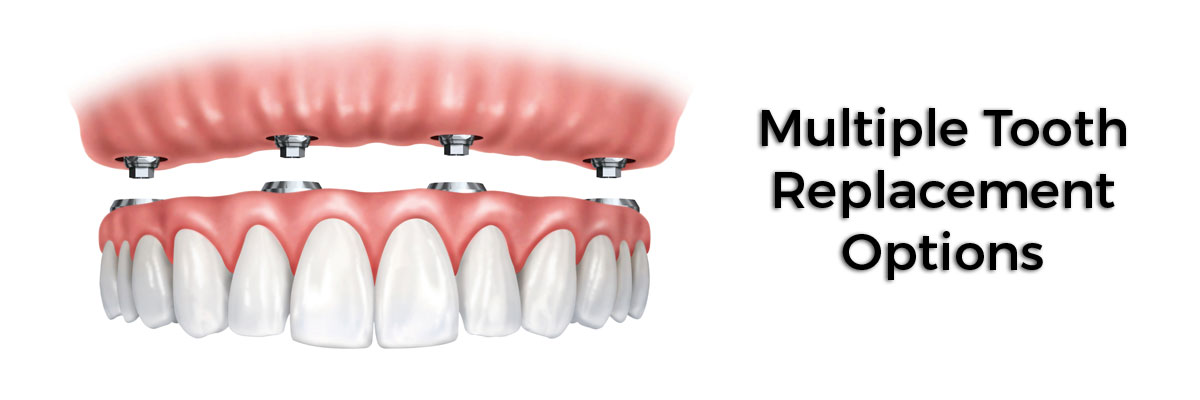 Playa Vista Multiple Teeth Replacement Options