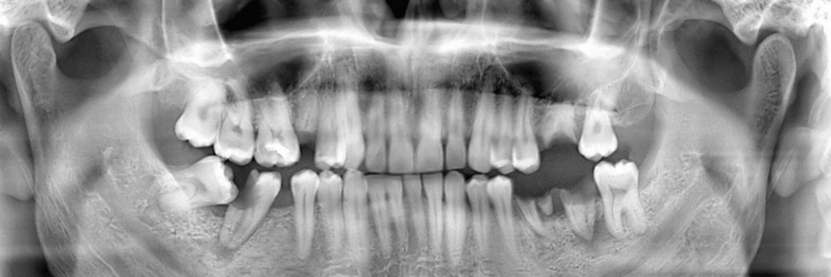 Playa Vista Options for Replacing Missing Teeth