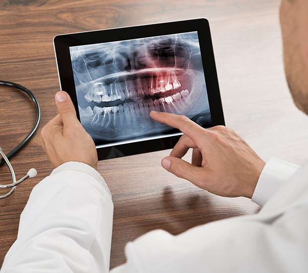 Playa Vista Types of Dental Root Fractures